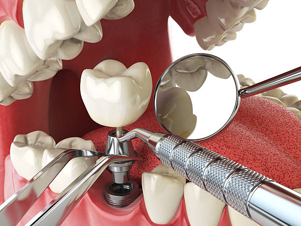 Best Emergency Root Canal Therapy in Salem, UT